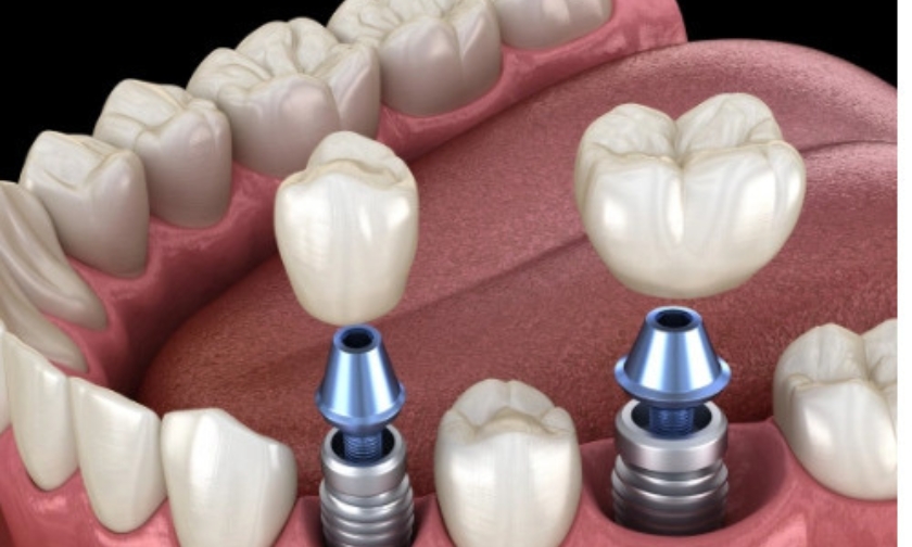 managing blood sugar for successful dental implants